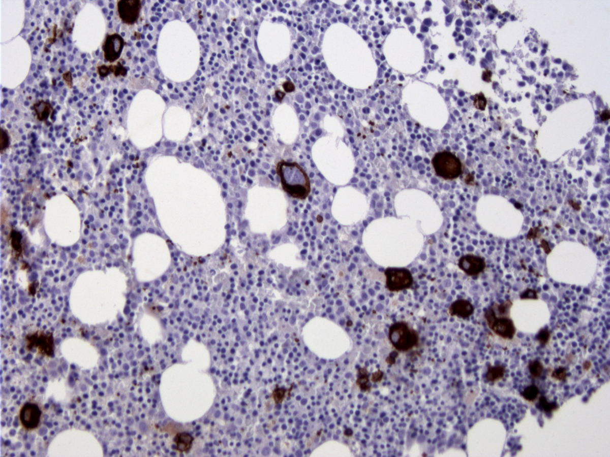 Bone marrow core biopsy section (BM-2), CD42b immunoperoxidase stain, x200